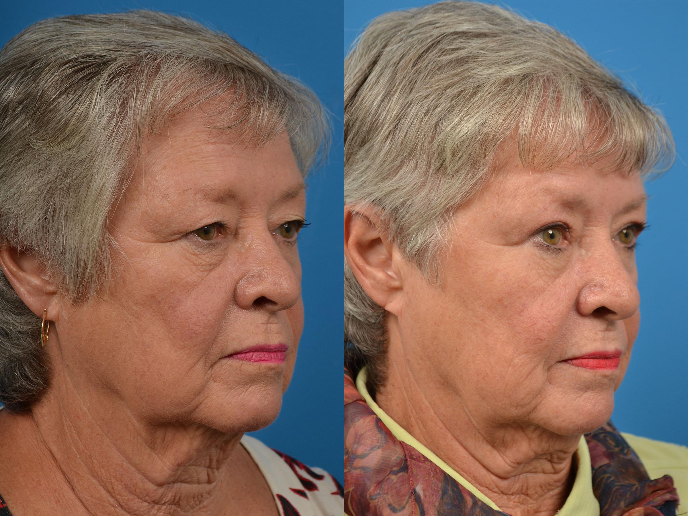 Brow Lift Photos Melbourne, FL Patient 56438
